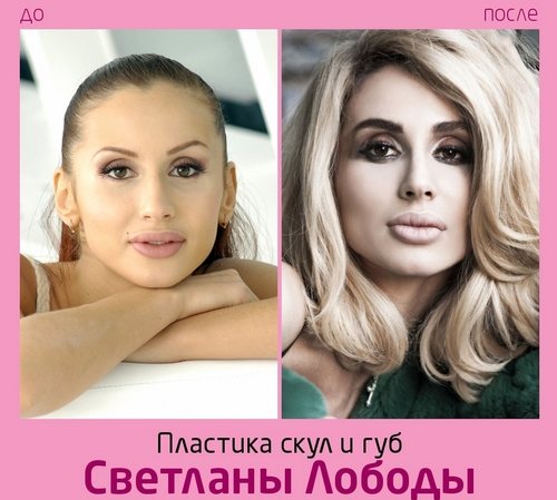 Светлана Лобода до и после пластики. Фото лица, носа, губ, груди. Биография певицы, возраст, параметры фигуры, рост и вес